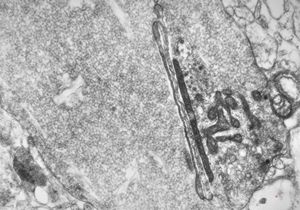 F,15y. | infantile neuroaxonal dystrophy (Seitelberger)